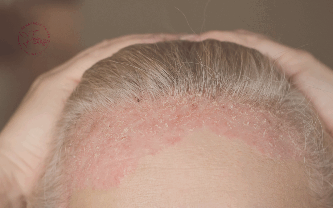Dermite séborrhéique : Causes, Symptômes et Solutions Naturelles Efficaces